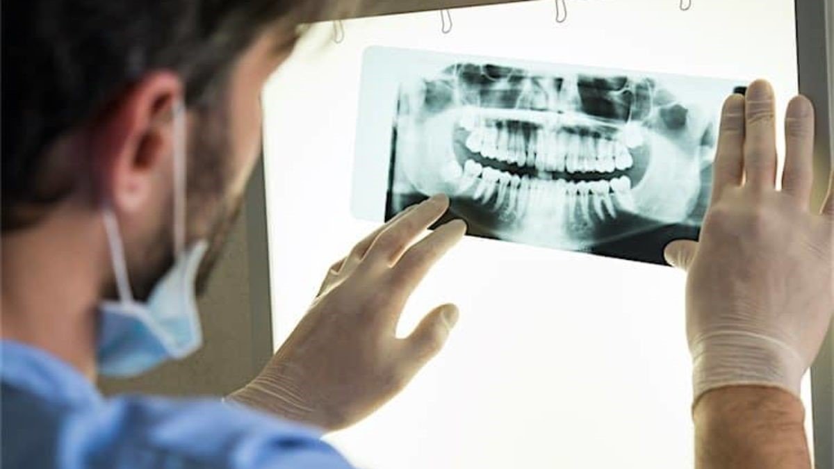 آموزش خواندن عکس دندان | تشخیص پوسیدگی دندان از روی عکس opg