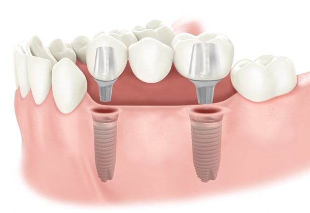 ایمپلنت | ایمپلنت دندان چقدر طول میکشد