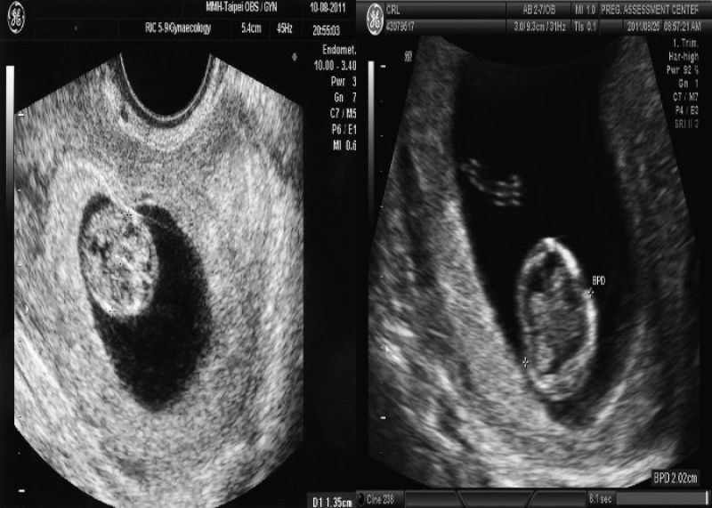 Why is the age of the fetus less in ultrasound