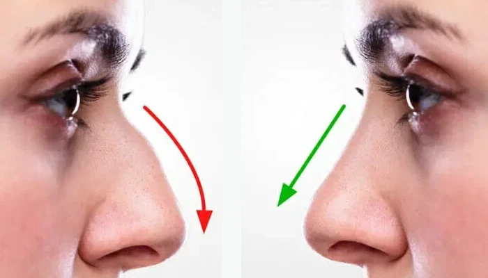 بهترین روش اصلاح فرم بینی بدون جراحی و عوارض