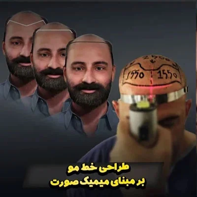 تهران تهران | کاشت مو