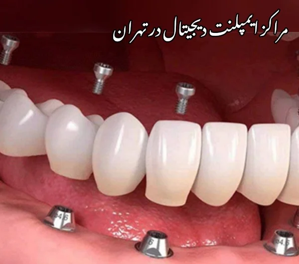 ایمپلنت