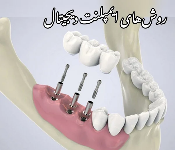 ایمپلنت ایمپلنت | تهران