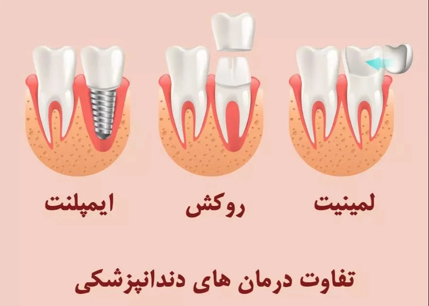 ایمپلنت