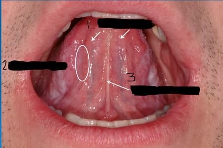 درمان تاول زیر زبان | درمان خانگی کیست زیر زبان