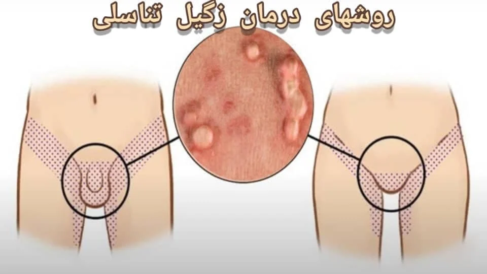 زگیل | زگیل تناسلی