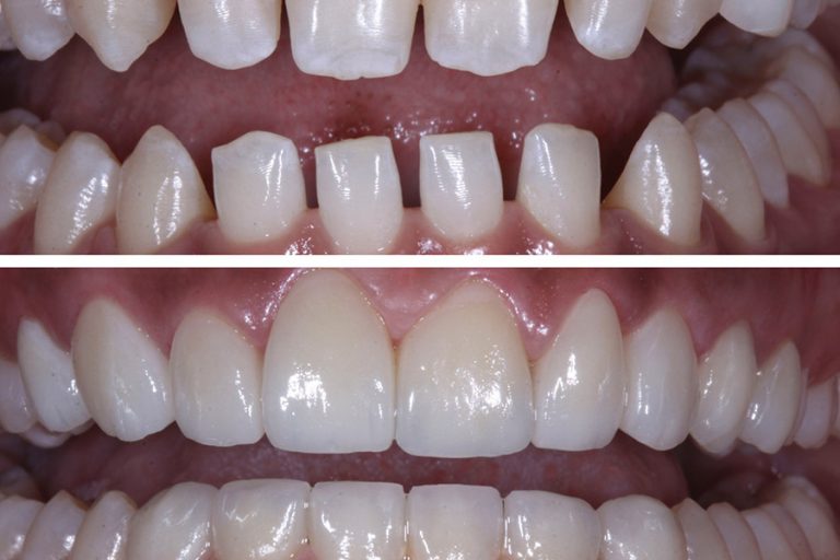 We have several types of dental laminates