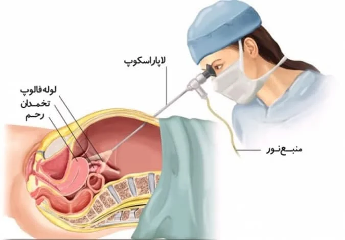 شکم بند بعد از عمل کیست تخمدان