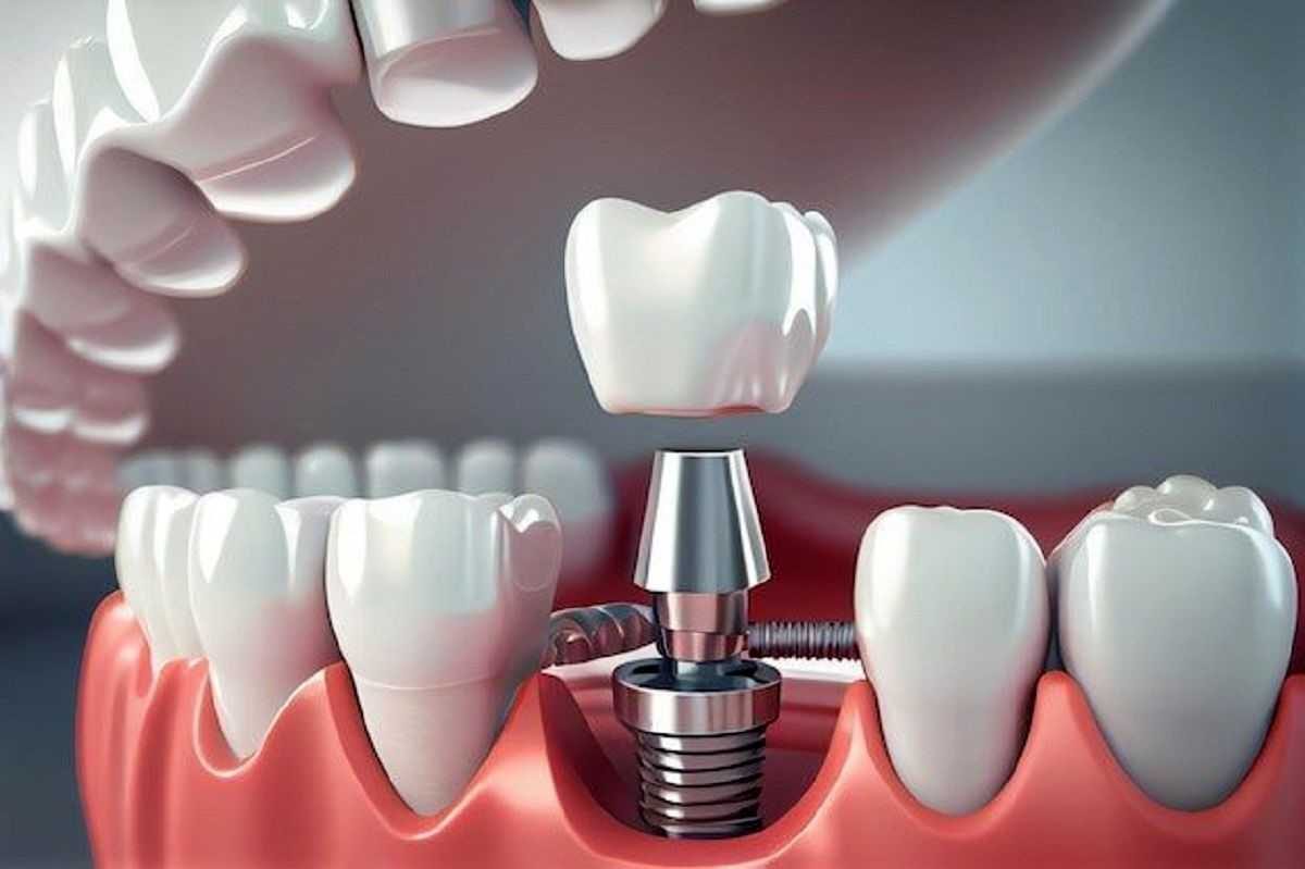 ایپملنت دندان | دندان