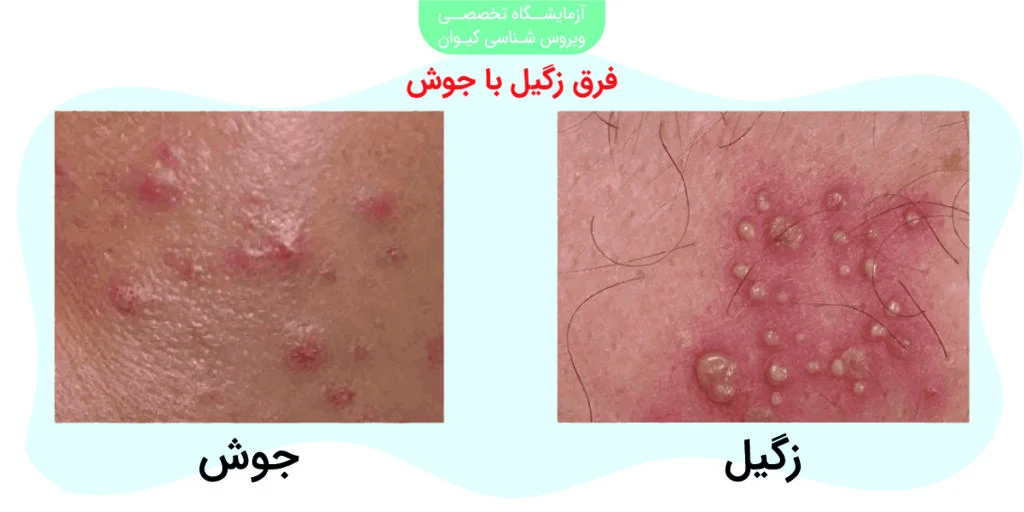 زگیل تناسلی