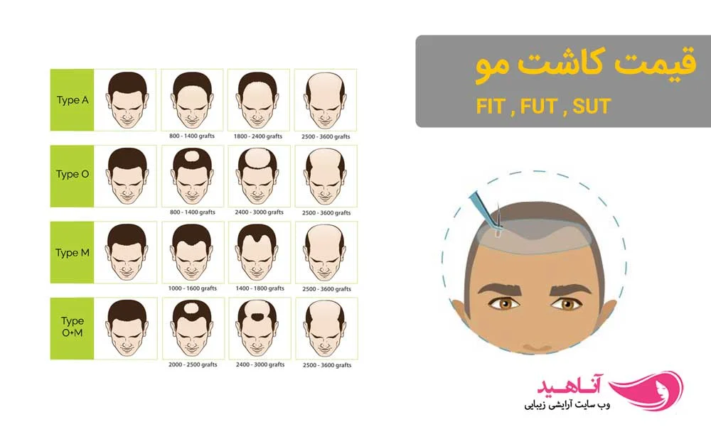 کاشت مو