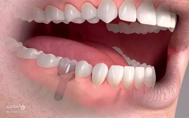 ایمپلنت ایمپلنت