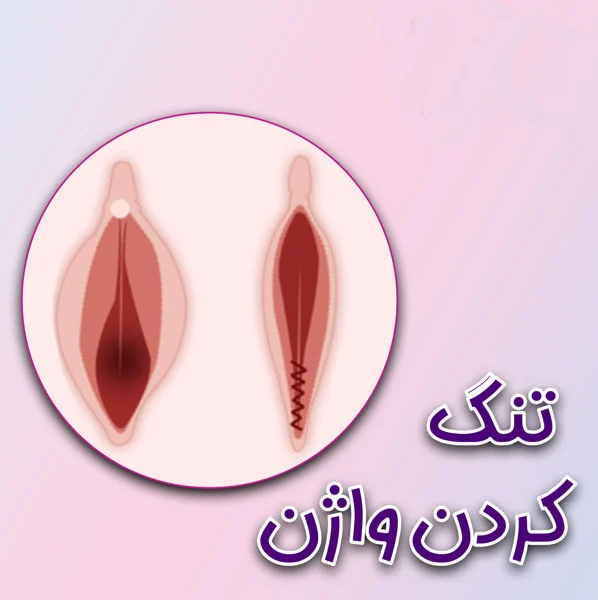 راهنمای جامع روش های تنگ کردن واژن؛ از ورزش کگل تا جراحی واژینوپلاستی