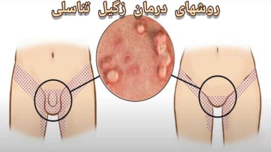 زگیل | زگیل تناسلی