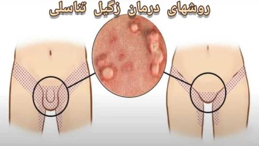 زگیل زگیل | زگیل تناسلی